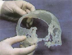 Ручная формовка имплантата на пластиковой копии черепа больного